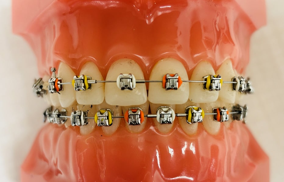 Candy Corn Braces
