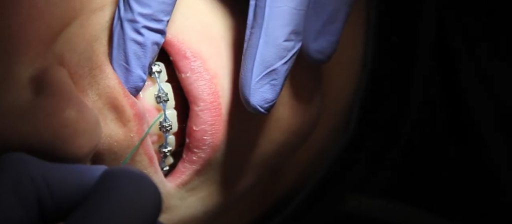 BLOG-flossing-with-braces
